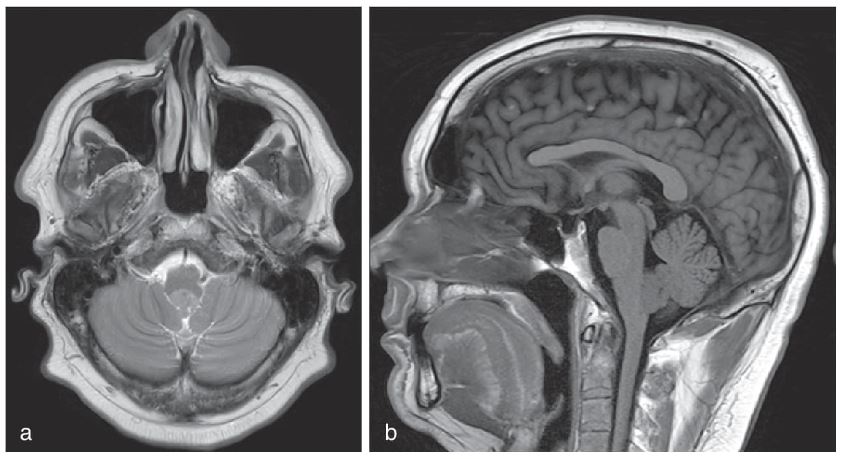 Aneurisma de la arteria cerebelosa posteroinferior - Figura 17.2.