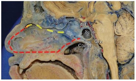 "Modificación del colgajo nasoseptal para implicar el suelo nasal."