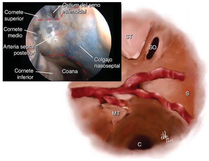 Técnica de inserción del colgajo nasoseptal en cirugía endonasal con reconstrucción multicapa.