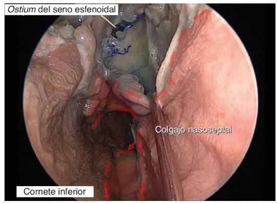 Diseño quirúrgico del colgajo nasoseptal para reconstrucción endoscópica de la base del cráneo.