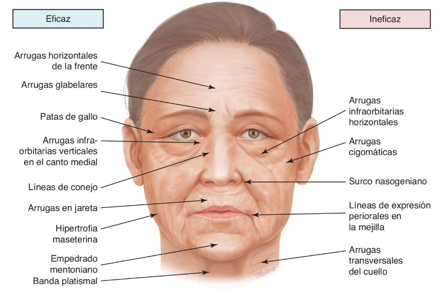 `alt`Figura 2.1. Indicaciones eficaces e ineficaces de la toxina botulínica para el tratamiento de las arrugas. `alt`