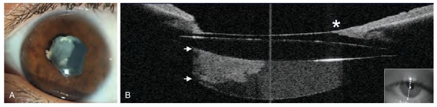 Figura 16.18. Proliferación de material retro-lente intraocular (LIO).
