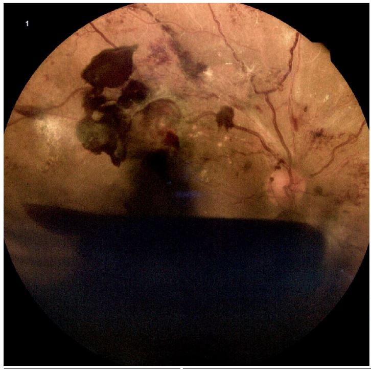`alt` Trastornos Vasculares de la Retina