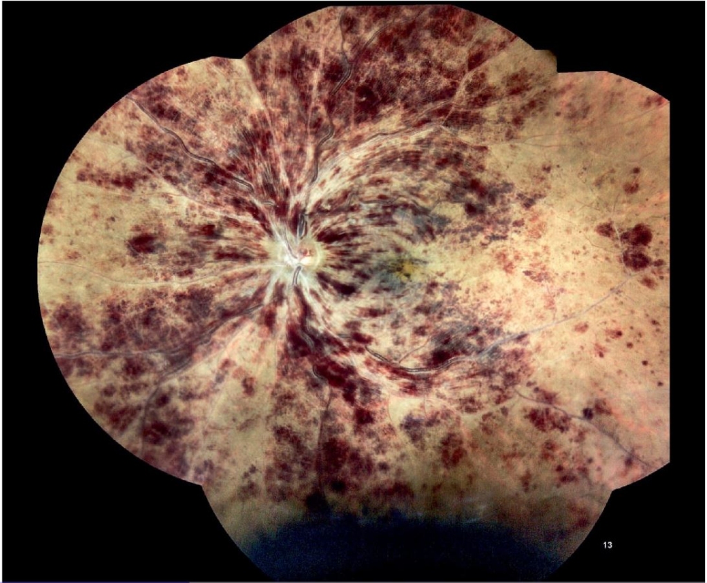 `alt` "Retinografía que muestra conversión a CRVO isquémica con patrón de sangre y truenos"