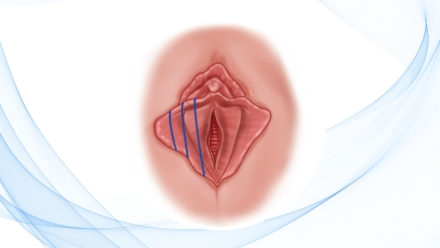 blog-implicaciones-postquirurgicas-de-una-labioplastia