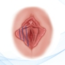 ¿Qué sucede después de una Labioplastia?: Implicaciones Postquirúrgicas de la cirugía para la hipertrofia de labios menores