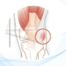 Síndromes de dolor de rodilla: el síndrome del corredor y la bursitis de la banda iliotibial