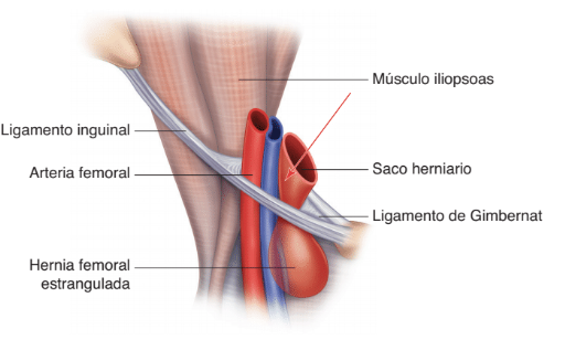 hernia-femoral
