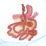 Obstrucciones intestinales tras un bypass gástrico laparoscópico: impactación, estenosis, intususcepción y hernias internas