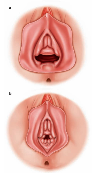 himenoplastia
