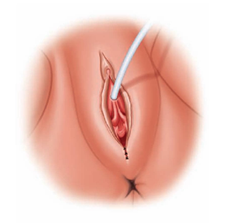 rejuvenecimiento-vaginal