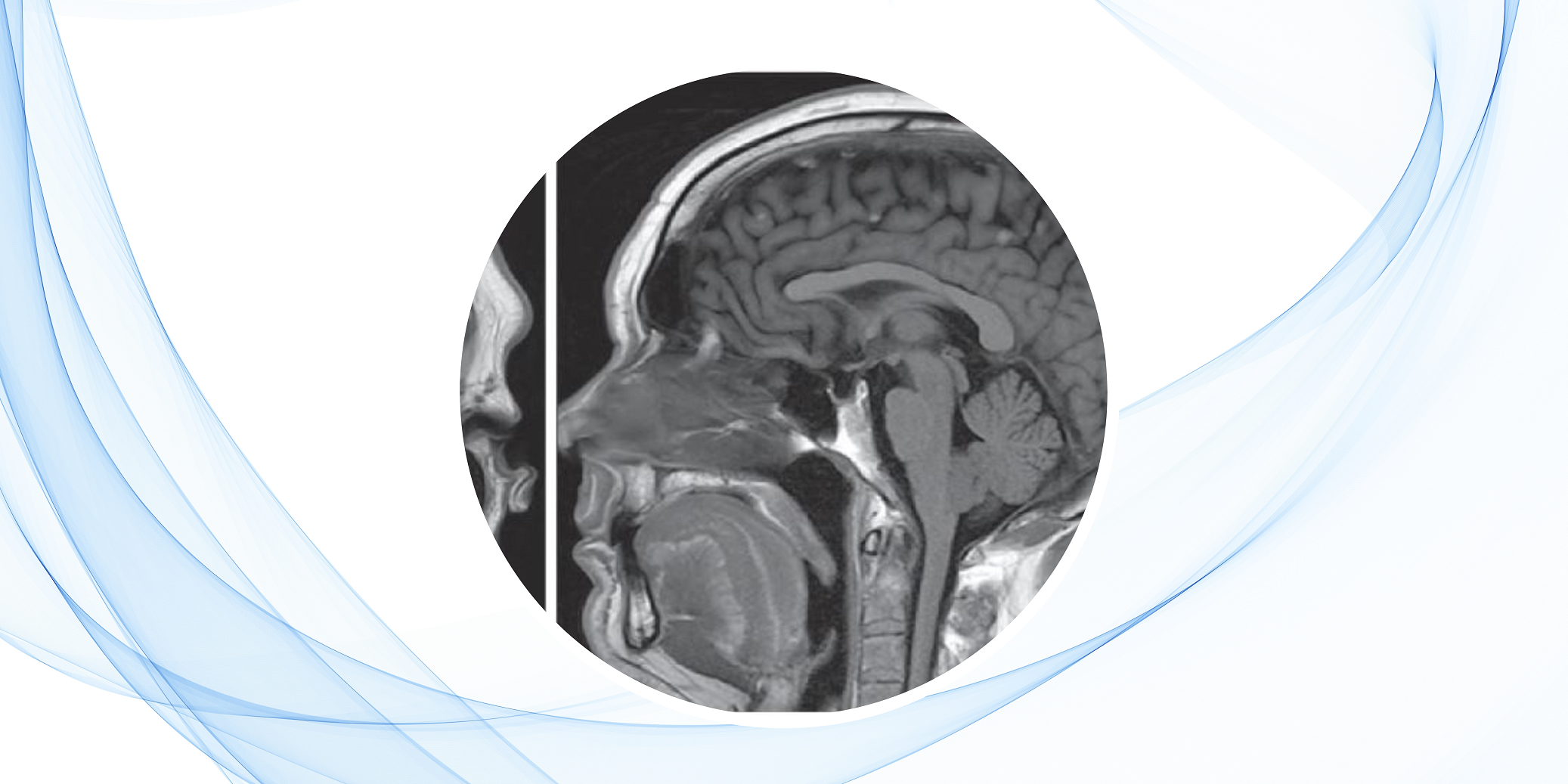 Aneurisma de la arteria cerebelosa posteroinferior: caso clínico y abordaje quirúrgico desde la anatomía del foramen magno