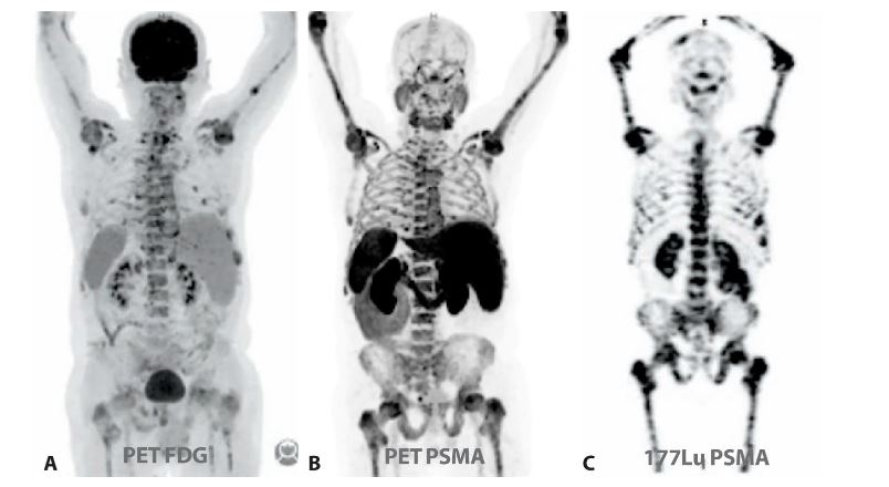 Primer caso de tratamiento con teragnosis con 177Lu – PSMA en cáncer de próstata en Perú. Paciente con cáncer de próstata resistente a la castración que progresó a varias líneas de tratamiento y presenta recurrencia bioquímica. Aquí mostramos las imágenes de preselección con A) PET FDG B) PET PSMA y el MIP de la adquisición de 24 horas posadministración de C) 177Lu PSMA. Cortesía%3A Dr. Javier Palomino.