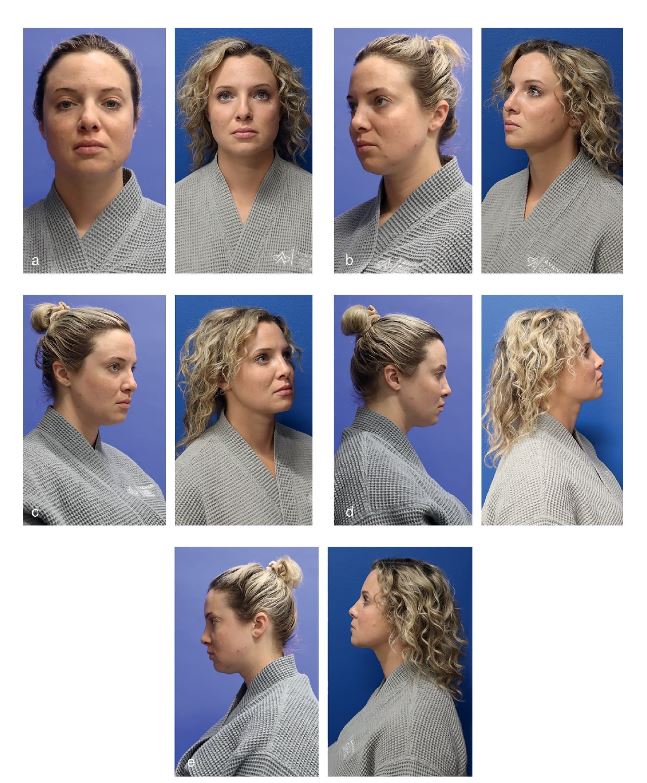`alt` Figura 11.1. (a-e) Mujer de 34 años de edad 6 meses después de la liposucción asistida por radiofrecuencia del cuello y la parte inferior de la cara con FaceTite (InMode)." Rejuvenecimiento del cuello por Samuel J. Lin