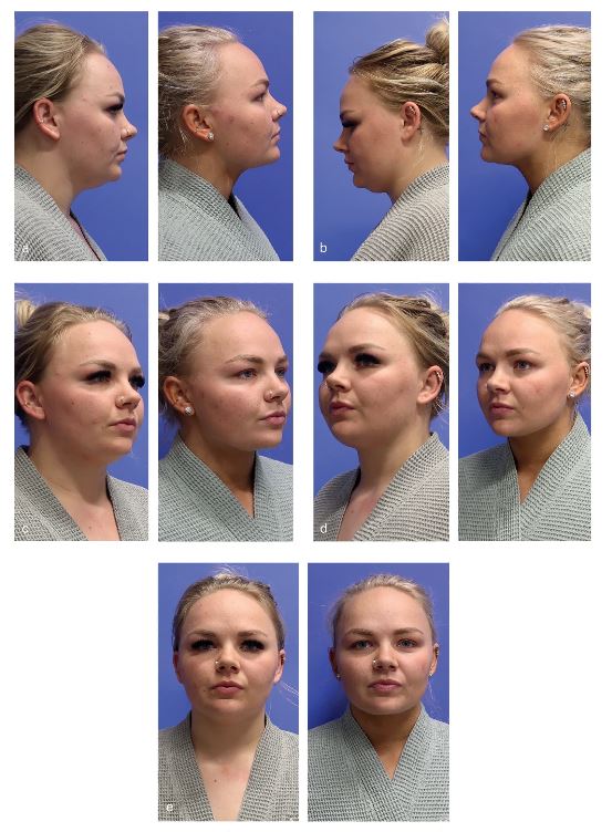 `alt` Figura 11.2. (a-e) Mujer de 24 años de edad 8 meses después de la liposucción asistida por radiofrecuencia del cuello y la parte inferior de la cara con FaceTite (InMode).
