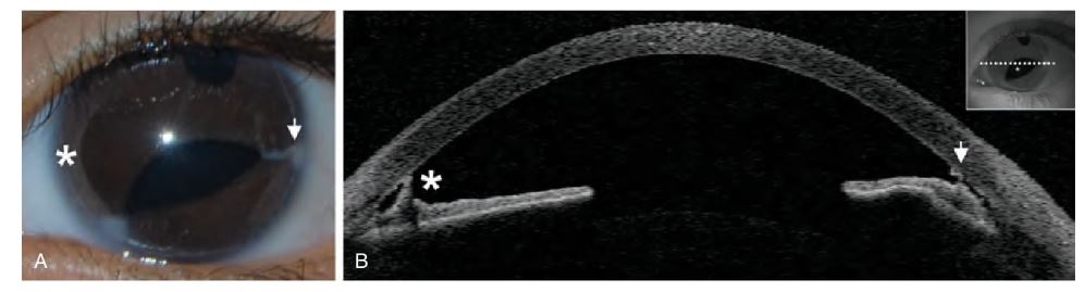 `alt` Figura 16.12. Corectopia y embriotoxón posterior asociados al síndrome de Axenfeld-Rieger. casos clínicos con OCT en córnea pediátrica