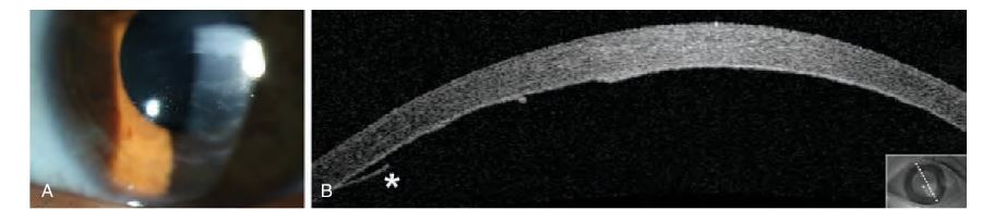 `alt` Figura 16.13. Estrías de Haab secundarias a glaucoma congénito primario. `alt`