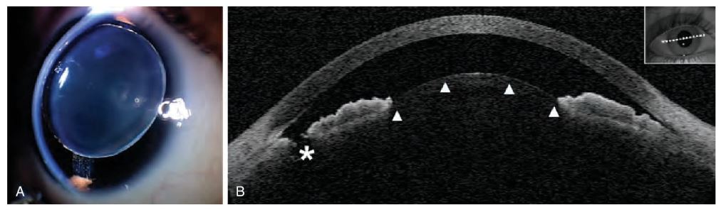 `alt` Figura 16.15. Microesferofaquia con subluxación anterior del cristalino.