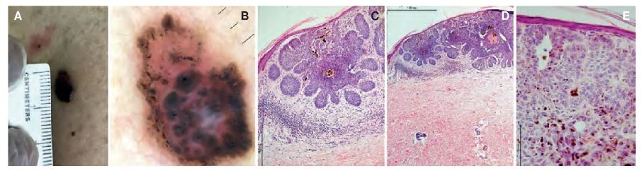`alt` Figura 27.2.Carcinoma basocelular nodular pigmentado.