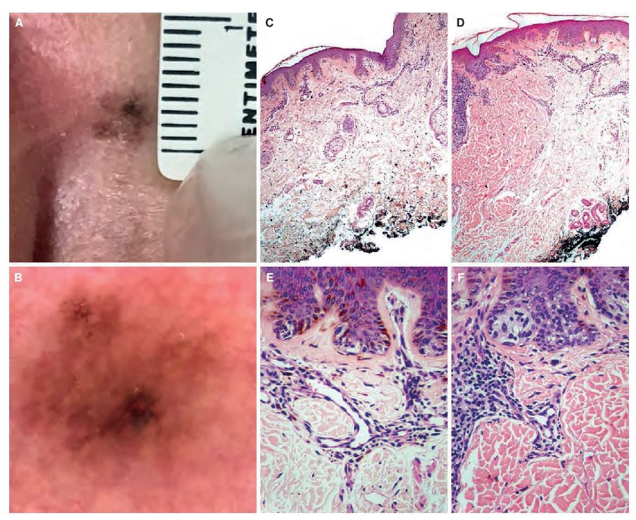 `alt` Figura 27.3. Nevo melanocítico de la unión con atipia citológica grave. correlación clínico-dermatoscópica-patológica