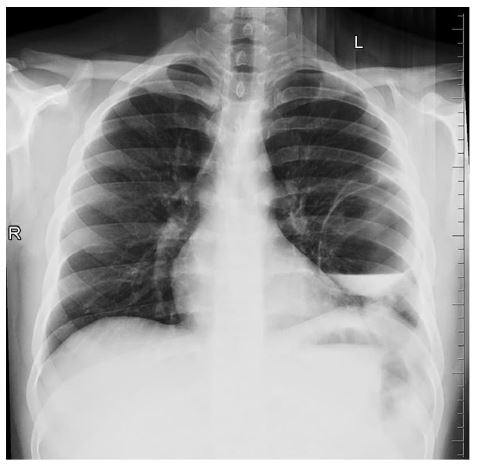 Figura 7.29. Absceso pulmonar del lóbulo inferior izquierdo. Cortesía: Dr. PV Venkata Sai, profesor de Radiología, (CERIS), SRMC & RI, SRIHER, Porur, Chennai.