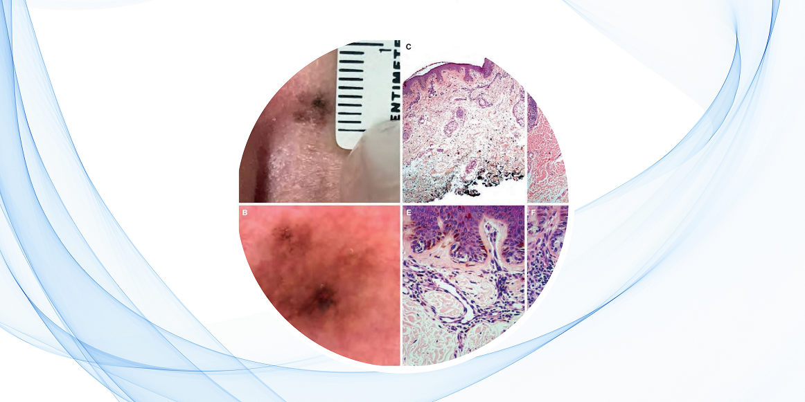 Correlación clínico-dermatoscópica-patológica: clave para un diagnóstico dermatológico preciso 