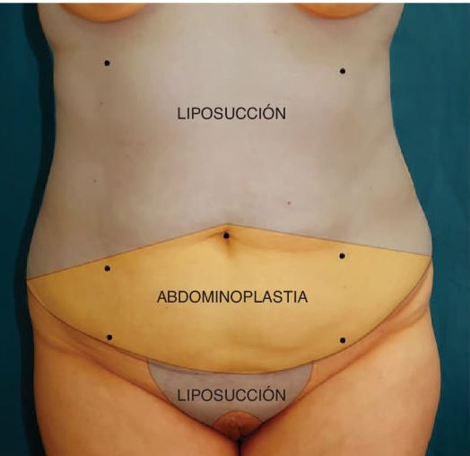Figura 5.1. Marcas quirúrgicas, vista anterior. `alt` evolución de la abdominoplastia
