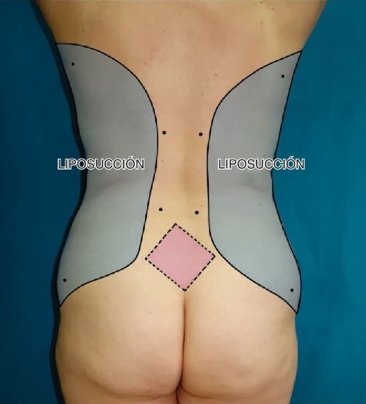 Figura  5.2. Marcas quirúrgicas, vista posterior. `alt` evolución de la abdominoplastia