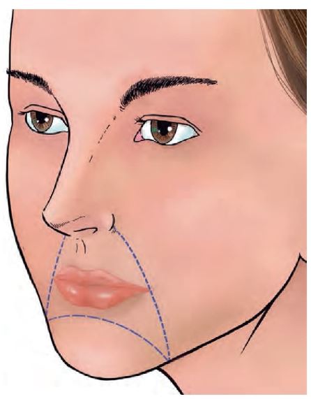 Figura 11.1. Unidad y subunidades labiales.  `alt` colgajos locales en labios y mentón 