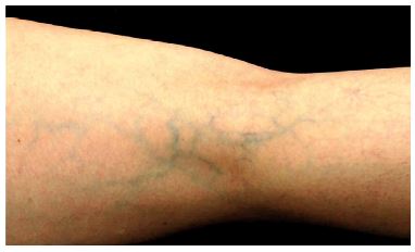 `alt` Telangiectasias rojas y azules tratamiento con láser - Venas reticulares de la fosa poplítea con paredes típicamente más finas y una buena respuesta al tratamiento.