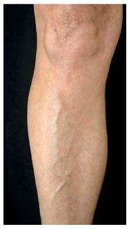 `alt` Telangiectasias rojas y azules tratamiento con láser - Venas reticulares en la superficie anterior de la pierna con paredes engrosadas y peor respuesta al tratamiento.