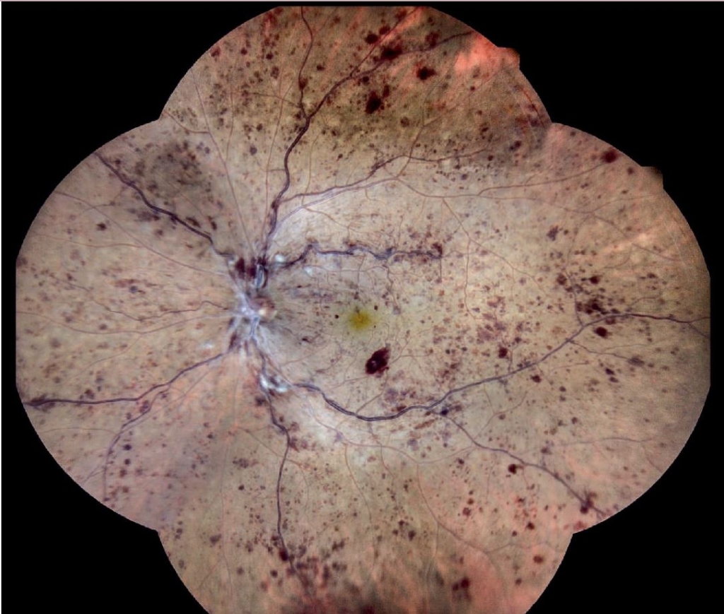`alt` "Retinografía en color de CRVO no isquémica con hemorragias dispersas y vasos tortuosos"