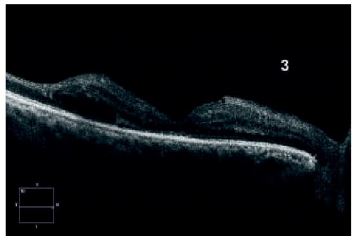 alt="Vitrectomía pars plana con gas intraocular y marcas de endoláser en retina"
