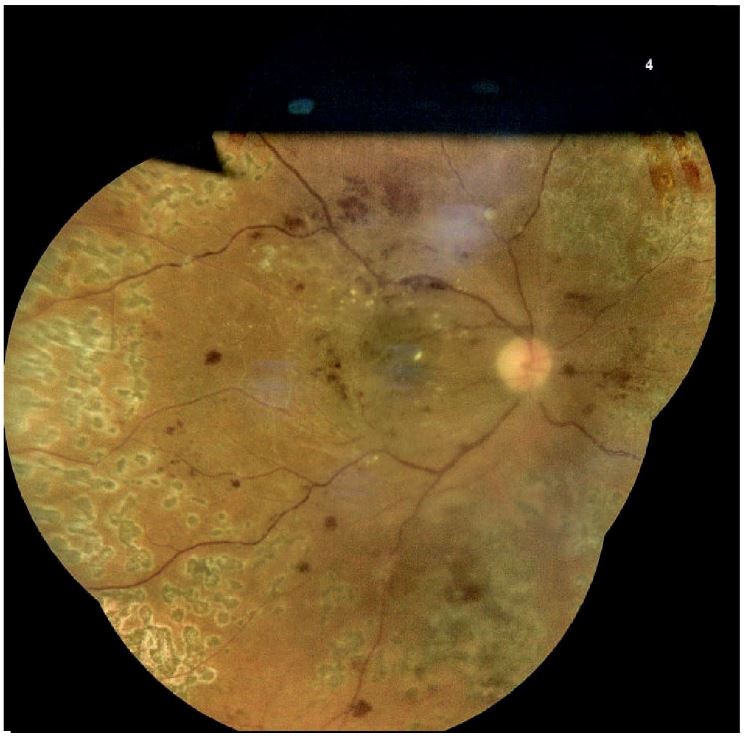 `alt` Trastornos Vasculares de la Retina