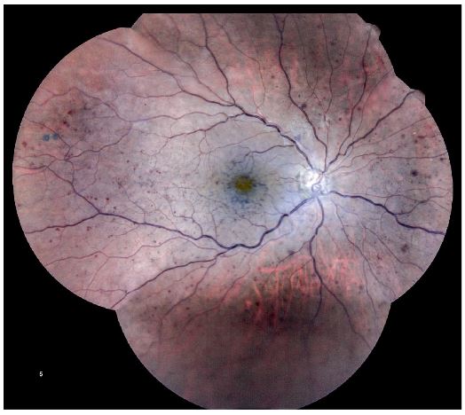 `alt` "Retinografía en color de CRVO no isquémica con hemorragias intrarretinianas y edema macular"