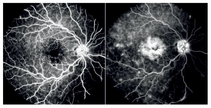 `alt` "Angiograma fluoresceínico inicial con puntos hipofluorescentes y red capilar perifoveal intacta"