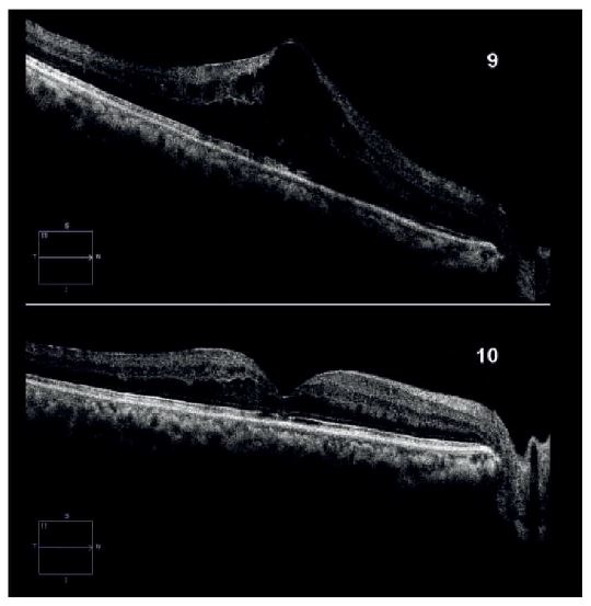 `alt` "OCT de dominio espectral con líquido quístico intrarretiniano por edema macular asociado a CRVO"