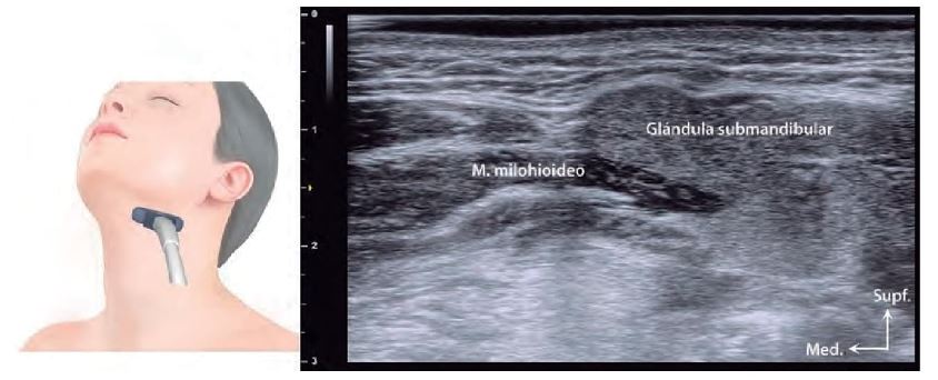 'alt' Figura 2. La imagen ecográfica muestra el músculo milohioideo y la glándula submandibular.
