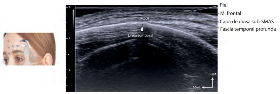 'alt' Figura 2. Se representa la relación entre el borde lateral del músculo frontal y la línea temporal. El músculo frontal aparece como una estructura hipoecoica, mientras que la grasa retroorbicular del ojo (ROOF) se ve como una estructura hiperecoica