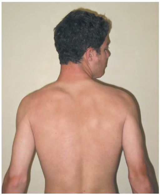 Figura 7.3.Rotación de la columna cervical.