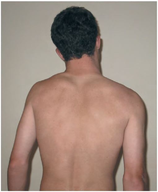 Figura 7.4.Flexión lateral de la columna cervical.