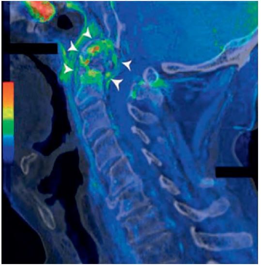 Figura  7.5.Tomografía  computarizada  y  resonancia  magnética  combina-das de la apófisis odontoides que muestran importantes erosiones óseas (fle-chas)y sinovitis (flechas)en un paciente que presenta dificultad para caminar e incontinencia urinaria y fecal. (De Parisot A, Ltaief-Boudrigua A, Villani A-P, et  al. Spontaneous  odontoid  fracture  on  a  tophus  responsible  for  spinal  cord  compression: a case report. Joint Bone Spine. 2013;80(5):550-551, Fig. 2).