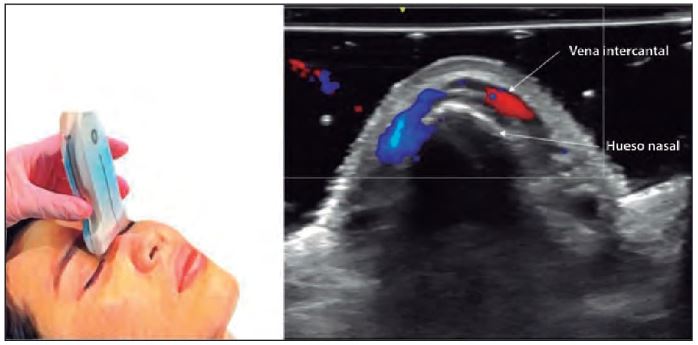 Figura 1. Rádix, imagen horizontal, vena intercantal. `alt` Ecografía nasal