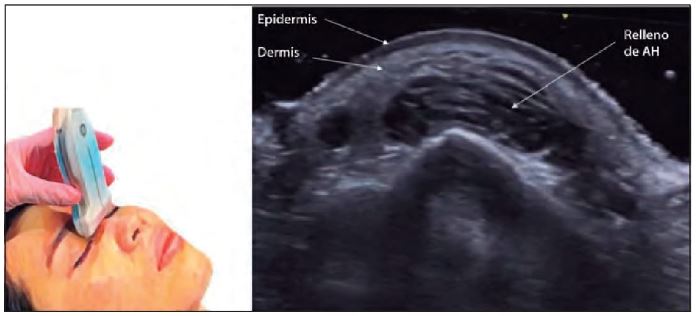 Figura 2. Rádix, imagen horizontal, múltiples depósitos pequeños de relleno de AH `alt` Ecografía nasal