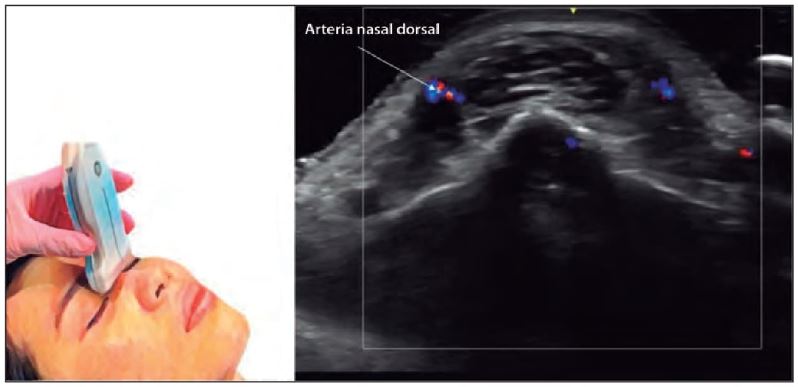 Figura 3. Rádix, imagen horizontal, arteria nasal dorsal, depósitos de AH `alt` Ecografía nasal