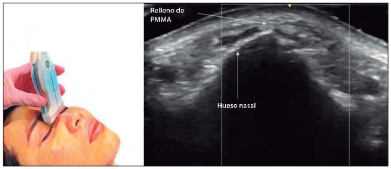Figura 4. Rádix, imagen horizontal, PMMA `alt` Ecografía nasal