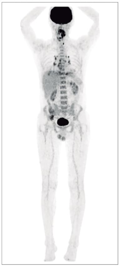 Figura 5.3. 18F-FDG con PET. Biodistribución anormal.