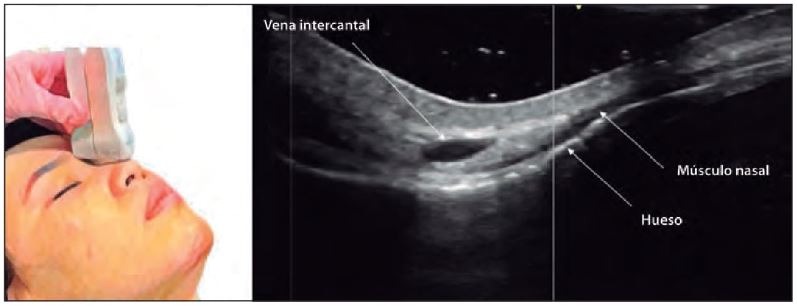 Figura 5. Rádix, imagen sagital, vena intercantal `alt` Ecografía nasal