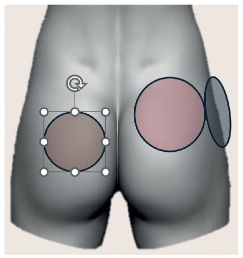 Figura 8.3. Zonas de remodelación. `alt` ácido poliláctico
