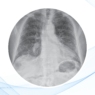 Fibrosis pulmonar idiopática: diagnóstico y manejo